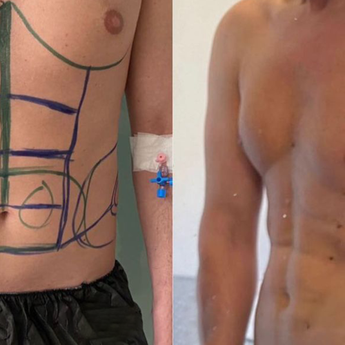 J plasma Renuvion Before / After photo